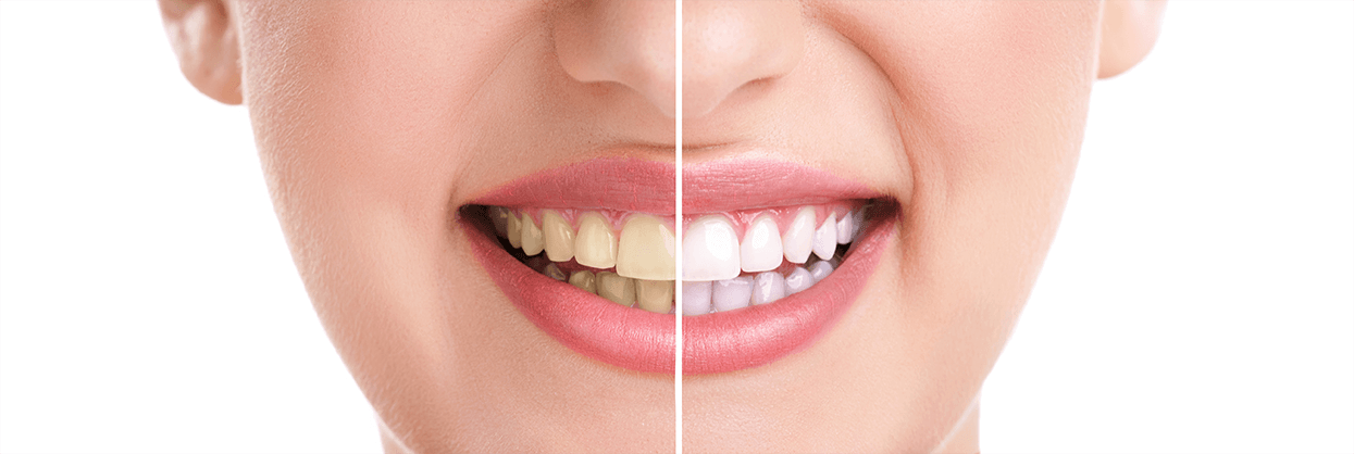 Teeth Whitening in Michigan and Indiana
