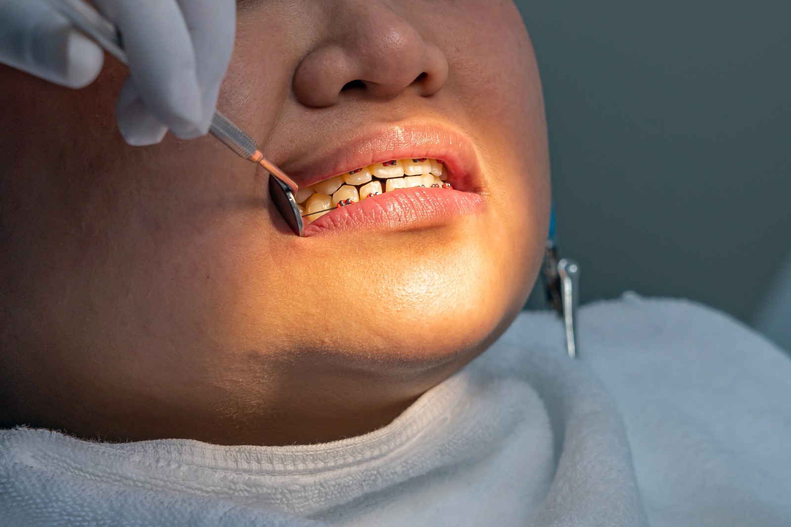 Dental-Bonding Dental-Bonding