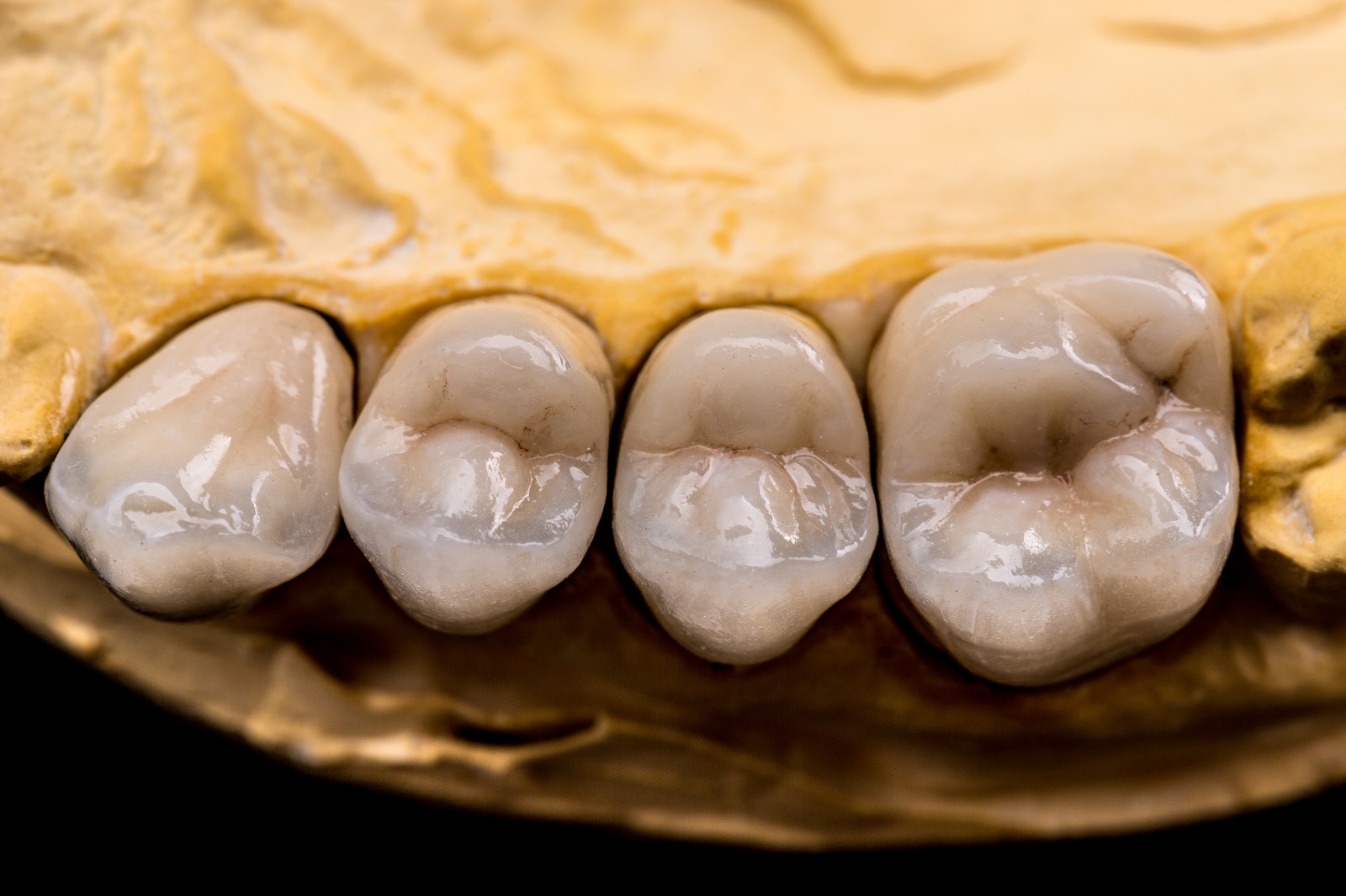 Dental-Se Dental sealants protecting the chewing surfaces of molars and premolars.