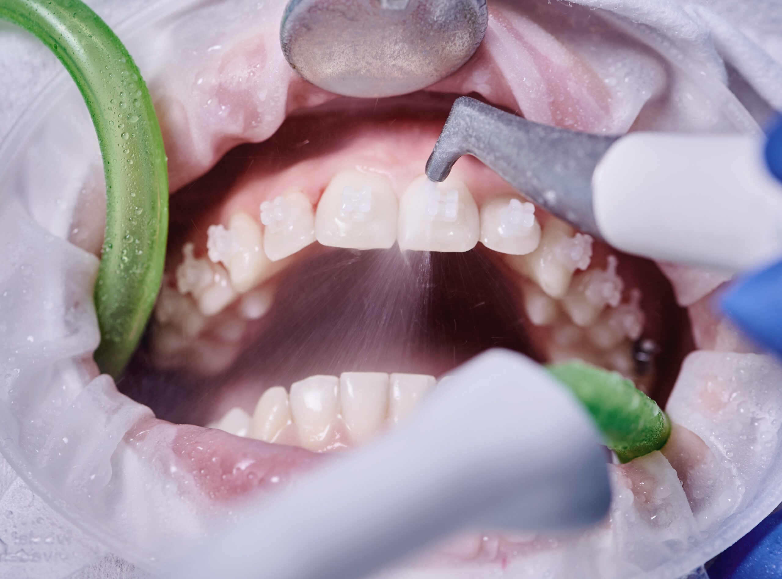dental-cleaning Dental cleaning procedure with scaling tools removing plaque and tartar from teeth.