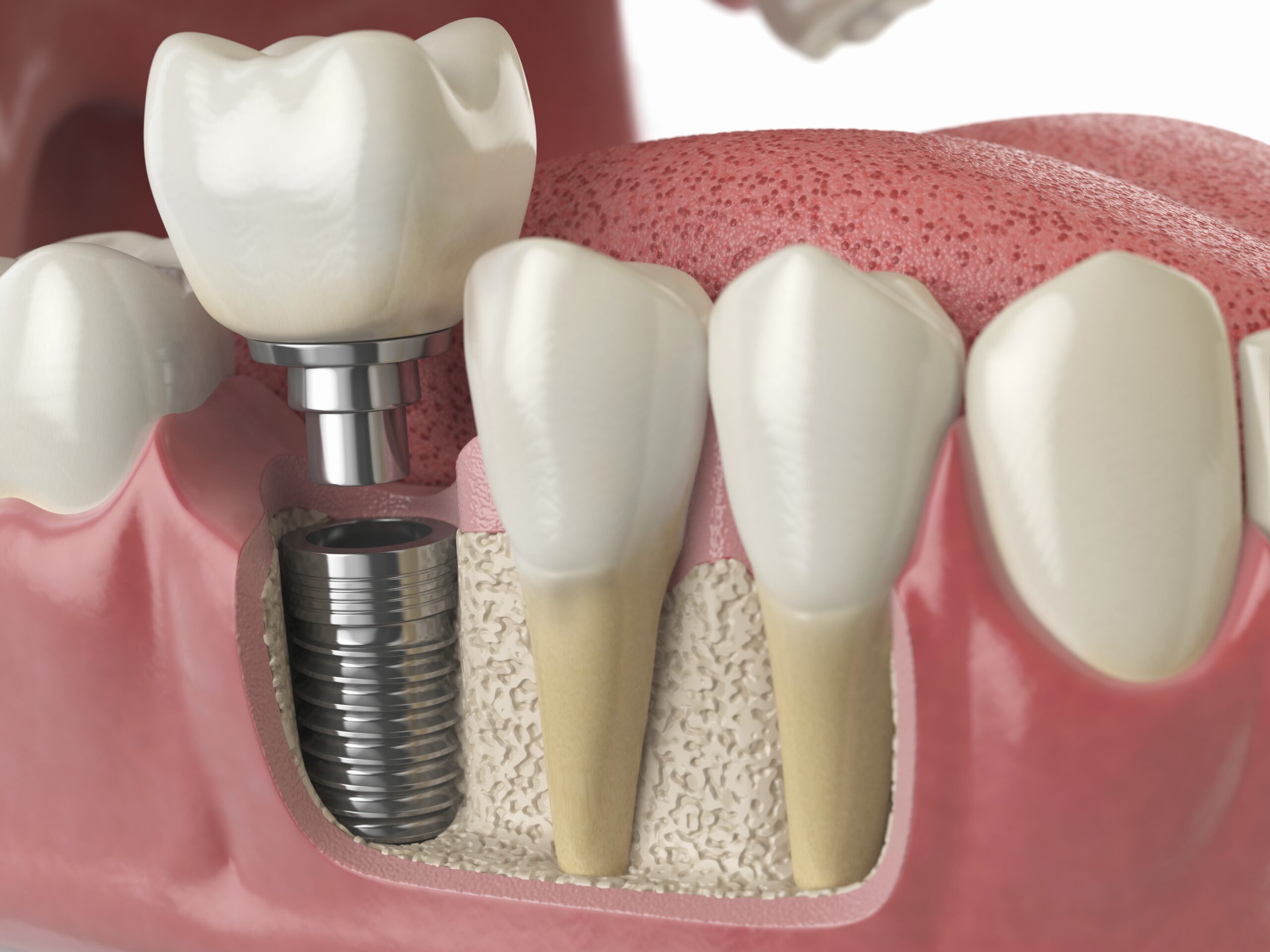 dental-implants dental-implants