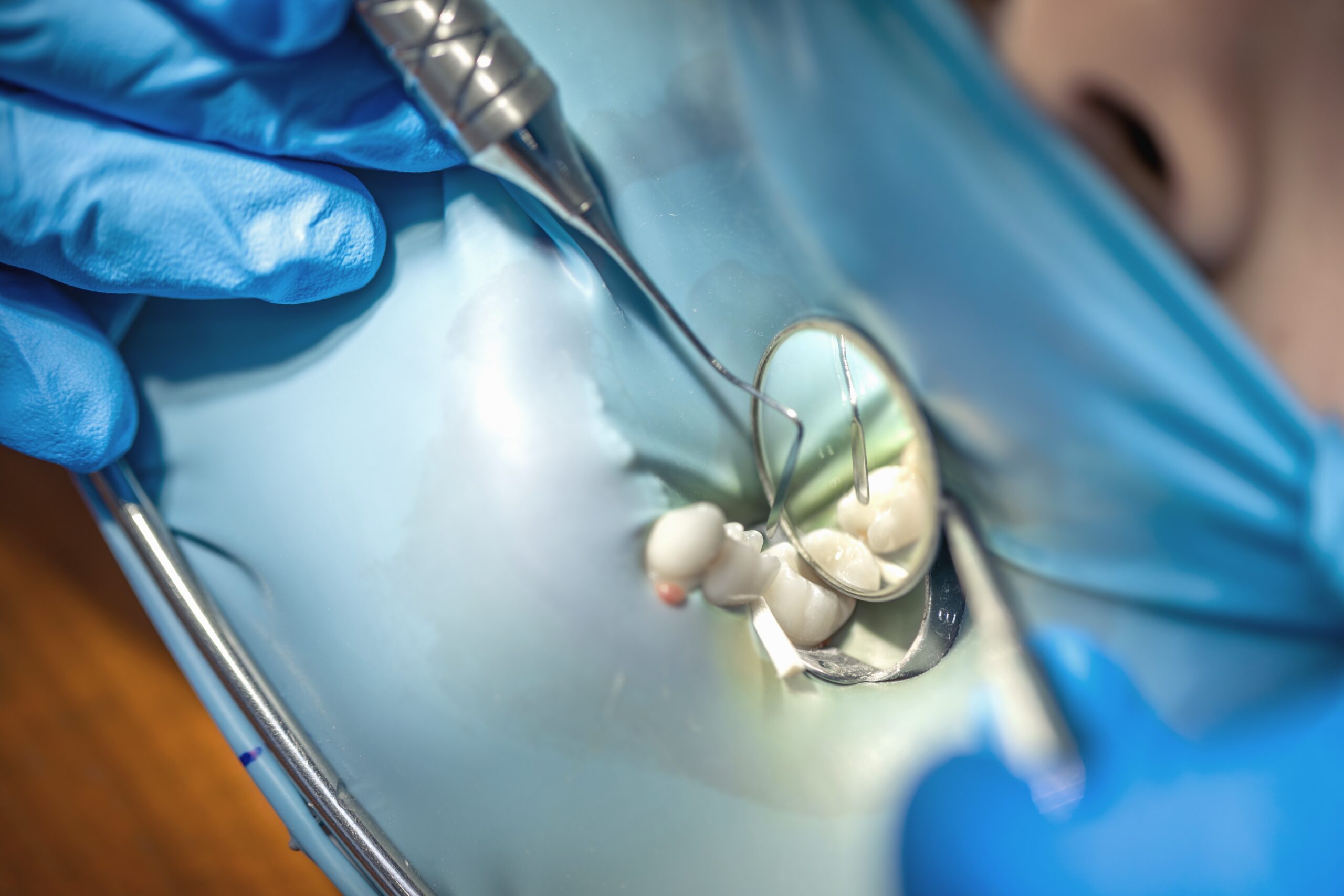 fillings