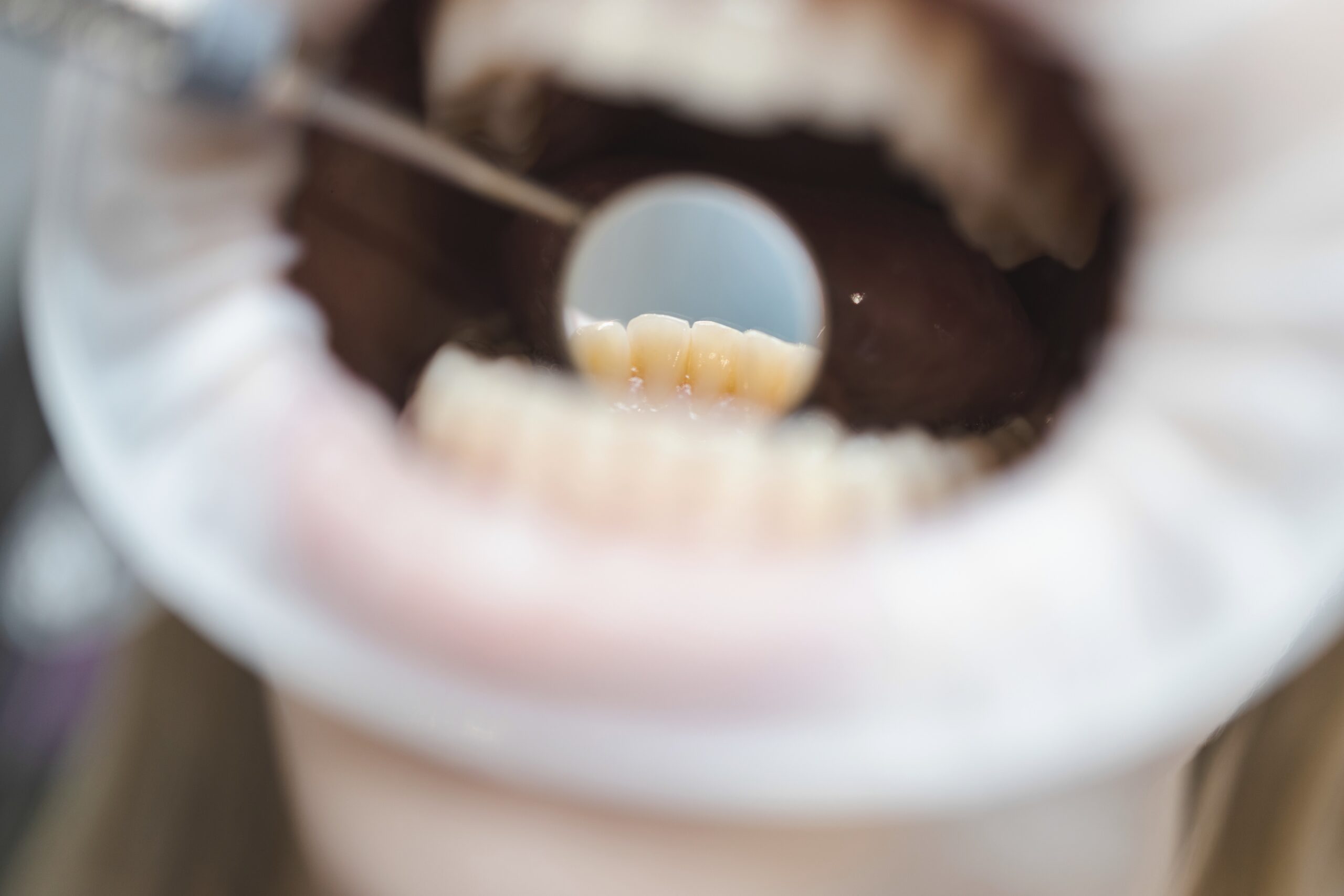 fluoride-treatment Dental hygienist applying fluoride treatment to teeth, strengthening enamel against cavities.