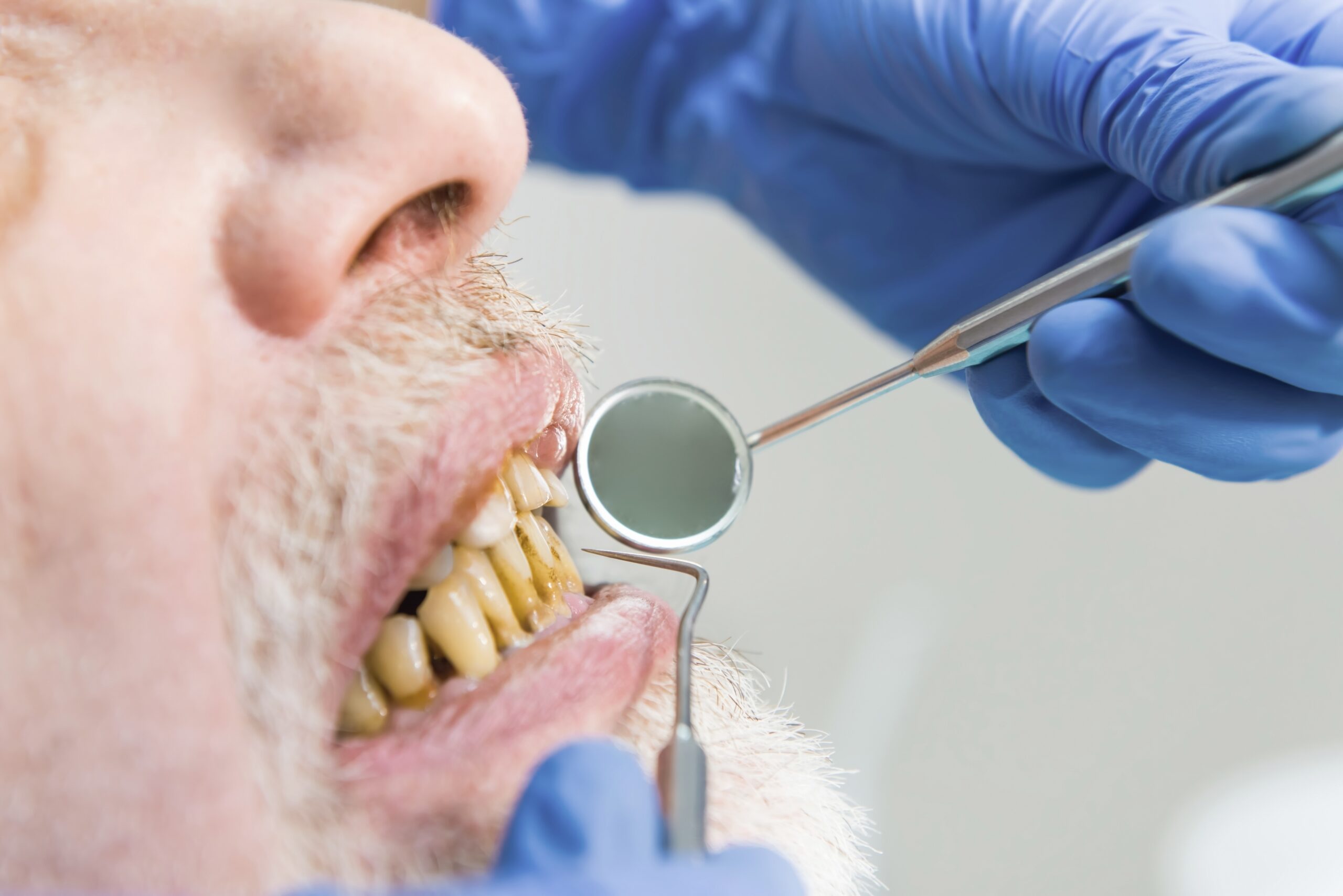 fluoride-treatments fluoride-treatments