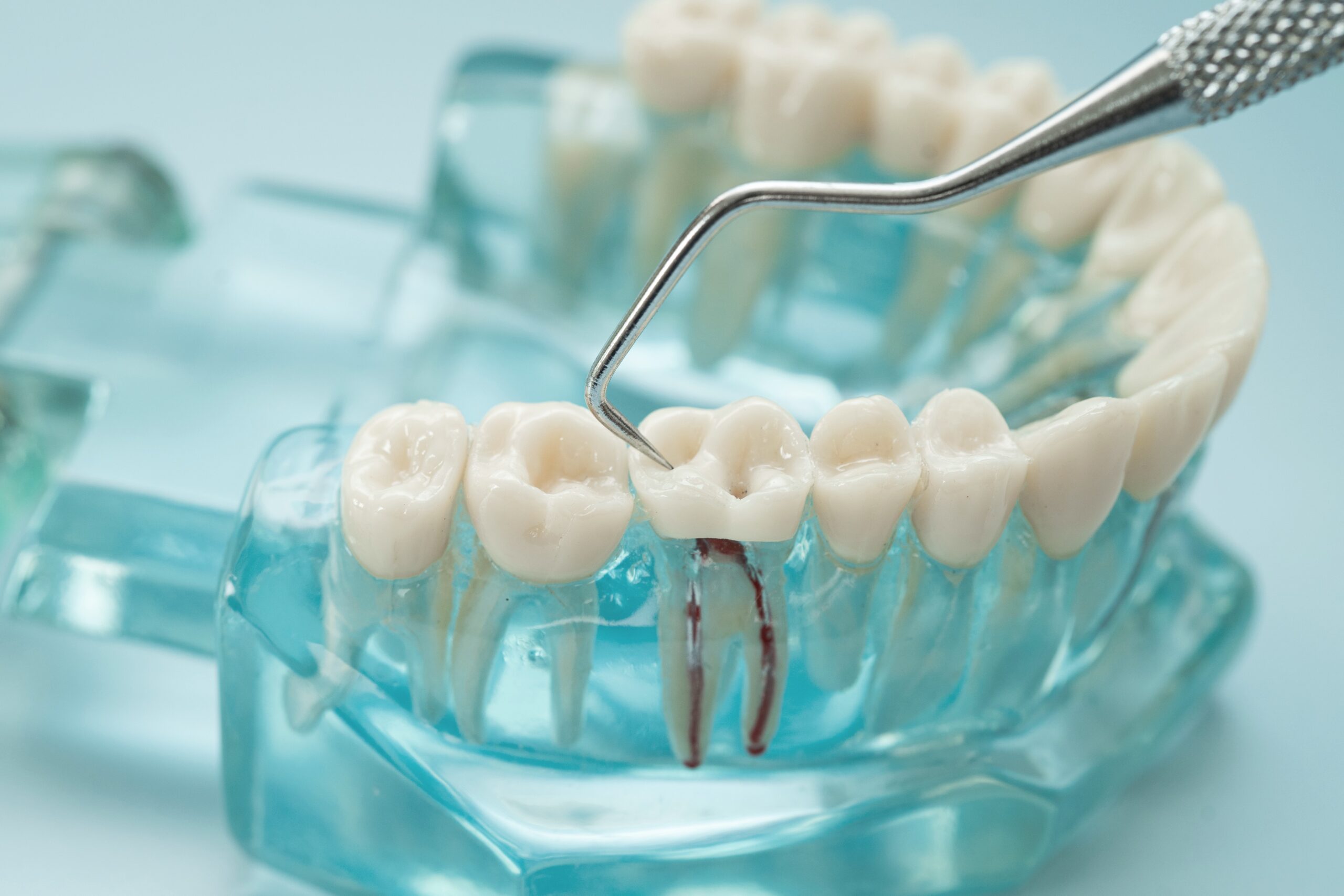 root-canal-treatment