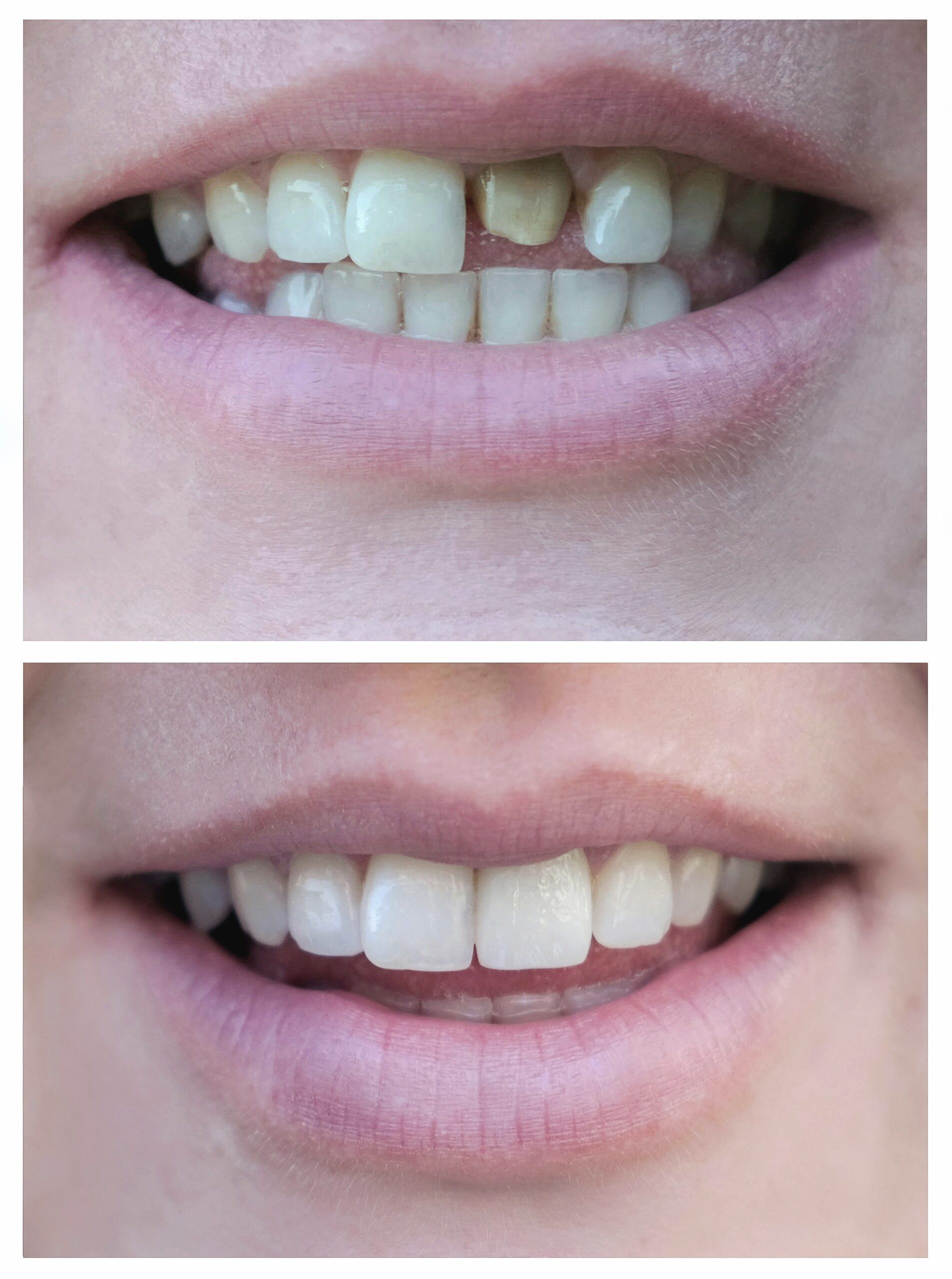 veneers