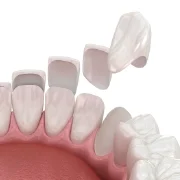 Dental Veneers