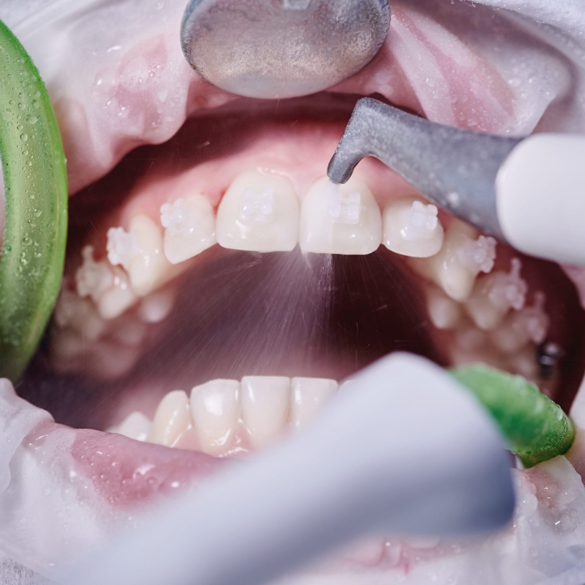 dental-cleaning