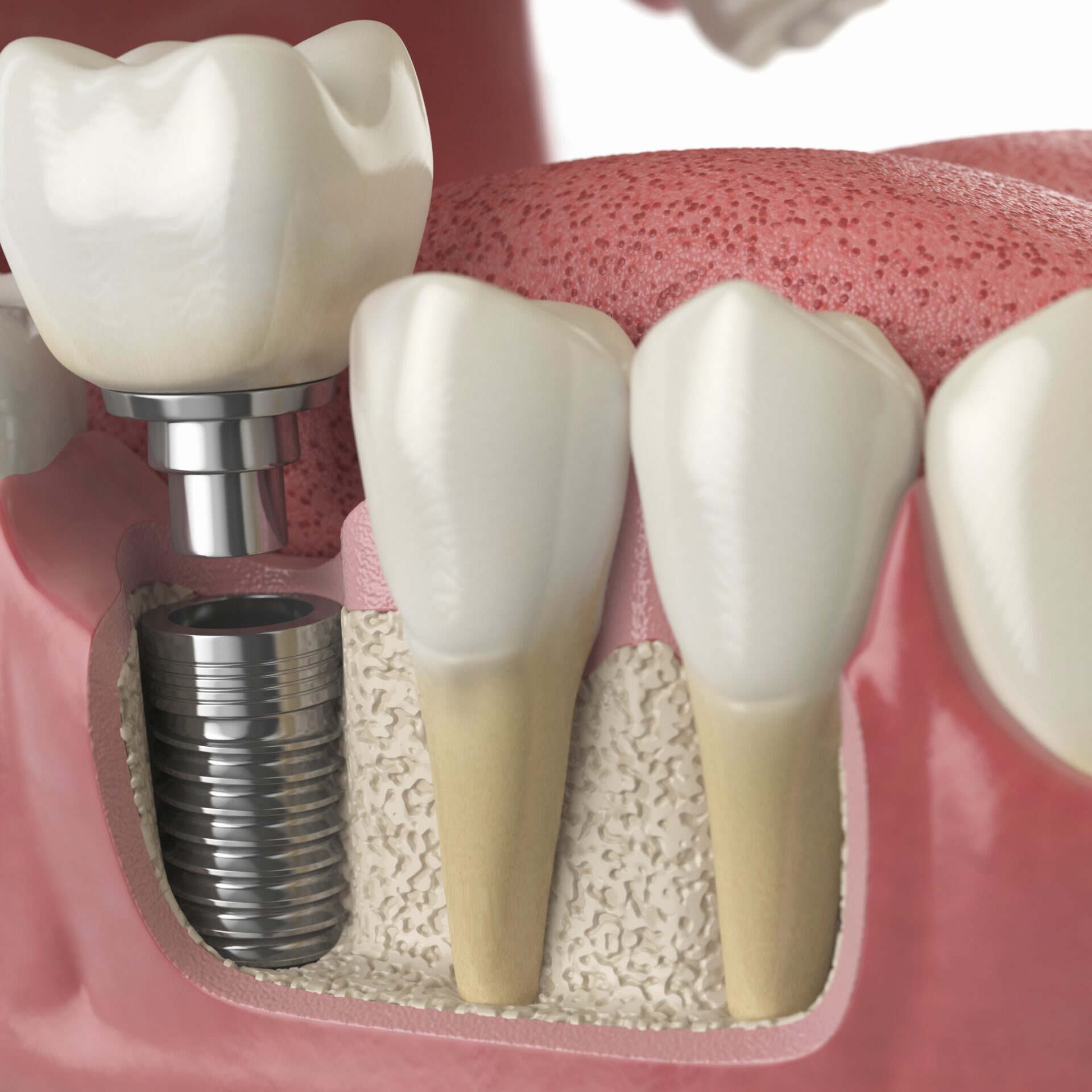 dental-implants