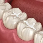 fillings