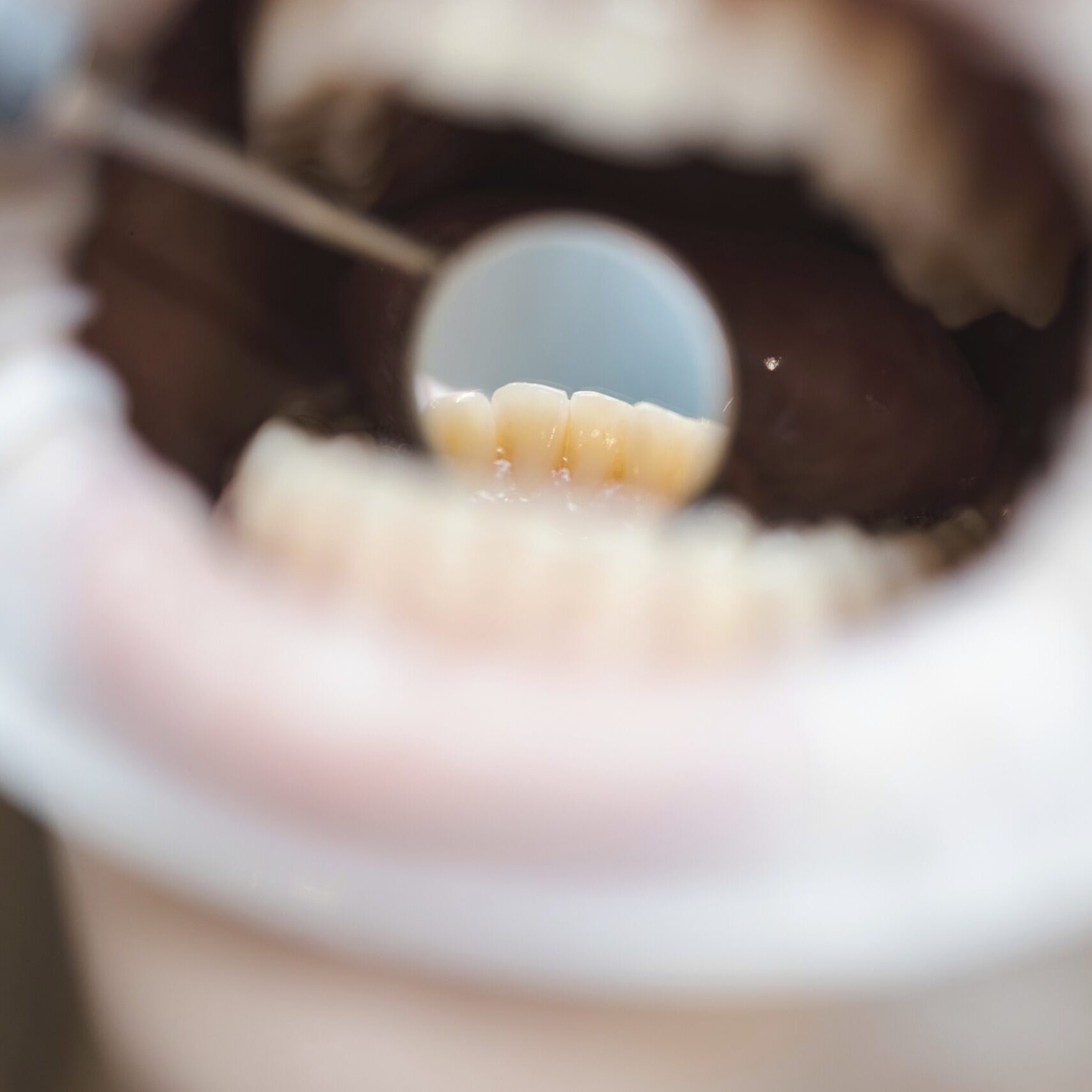 fluoride-treatment