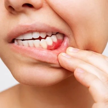 gum_disease