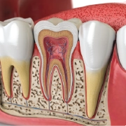 root-canal
