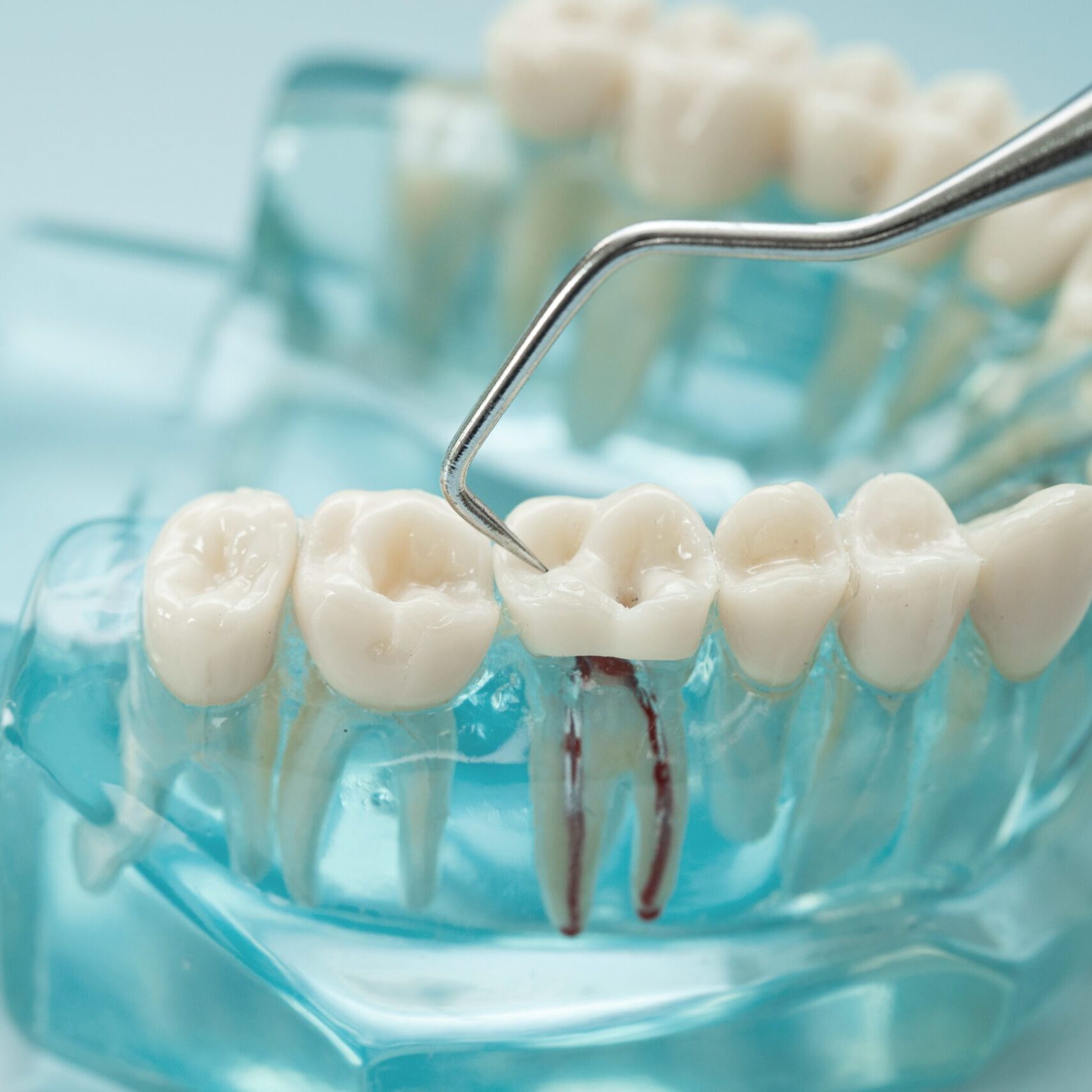root-canal-treatment